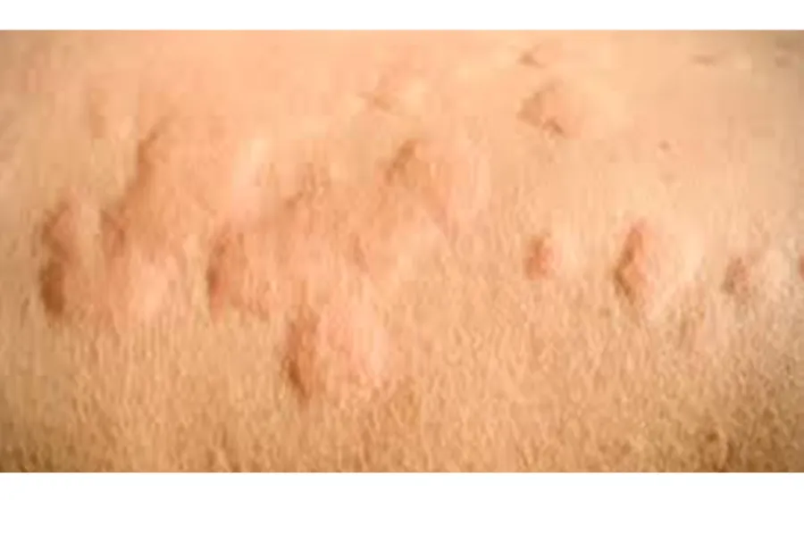 Close-up of hives (urticaria) on skin with swelling and redness