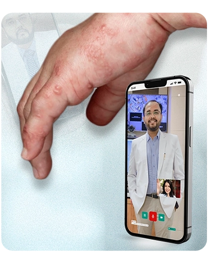 स्केबीज़ (खाज) रैश उपचार के लिए ऑनलाइन त्वचा विशेषज्ञ से परामर्श