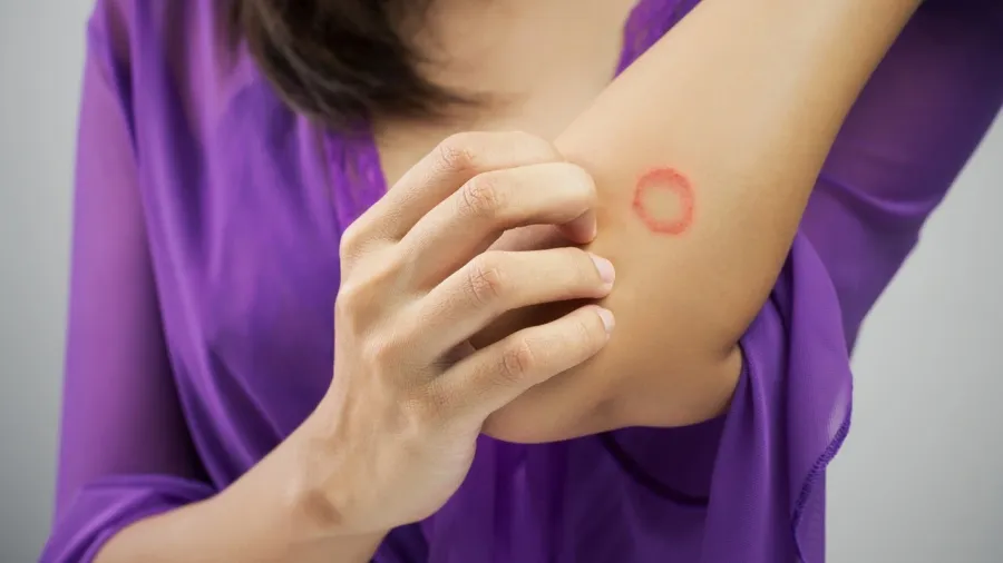 online dermatologist consultation for ringworm treatment, Ringworm Treatment, ringworm dermatologist online