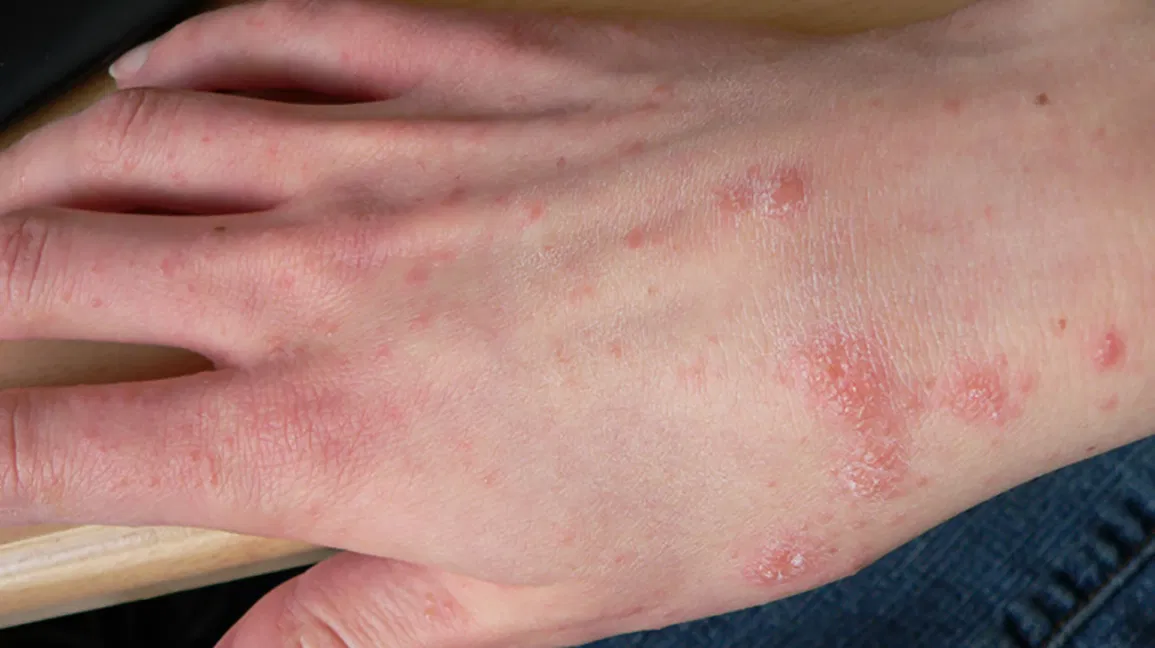 Online Scabies Disease Rash Treatment by Skin Specialist