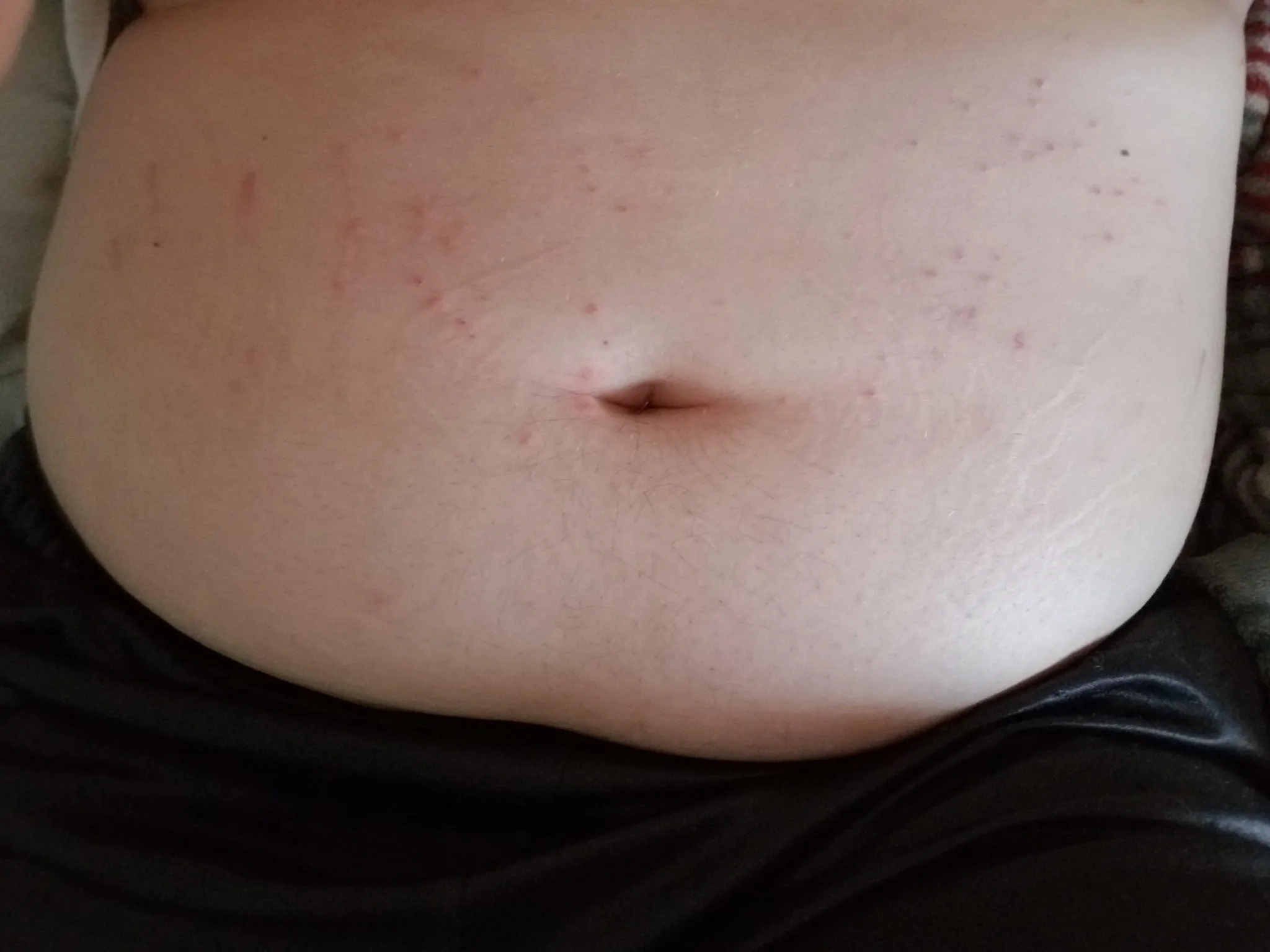 Types of Scabies Infection & How It Affects the Skin