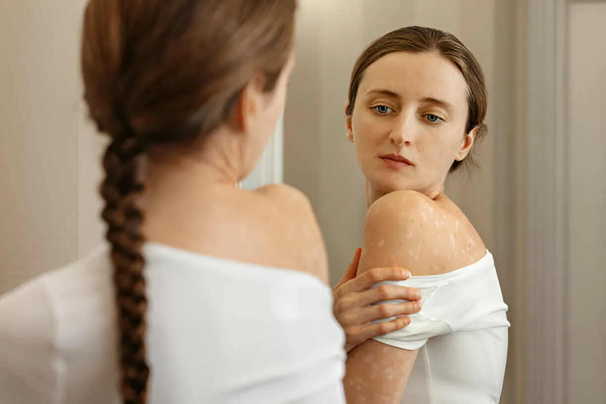 विटिलिगो के प्रकार और यह त्वचा को कैसे अफेक्ट करता है