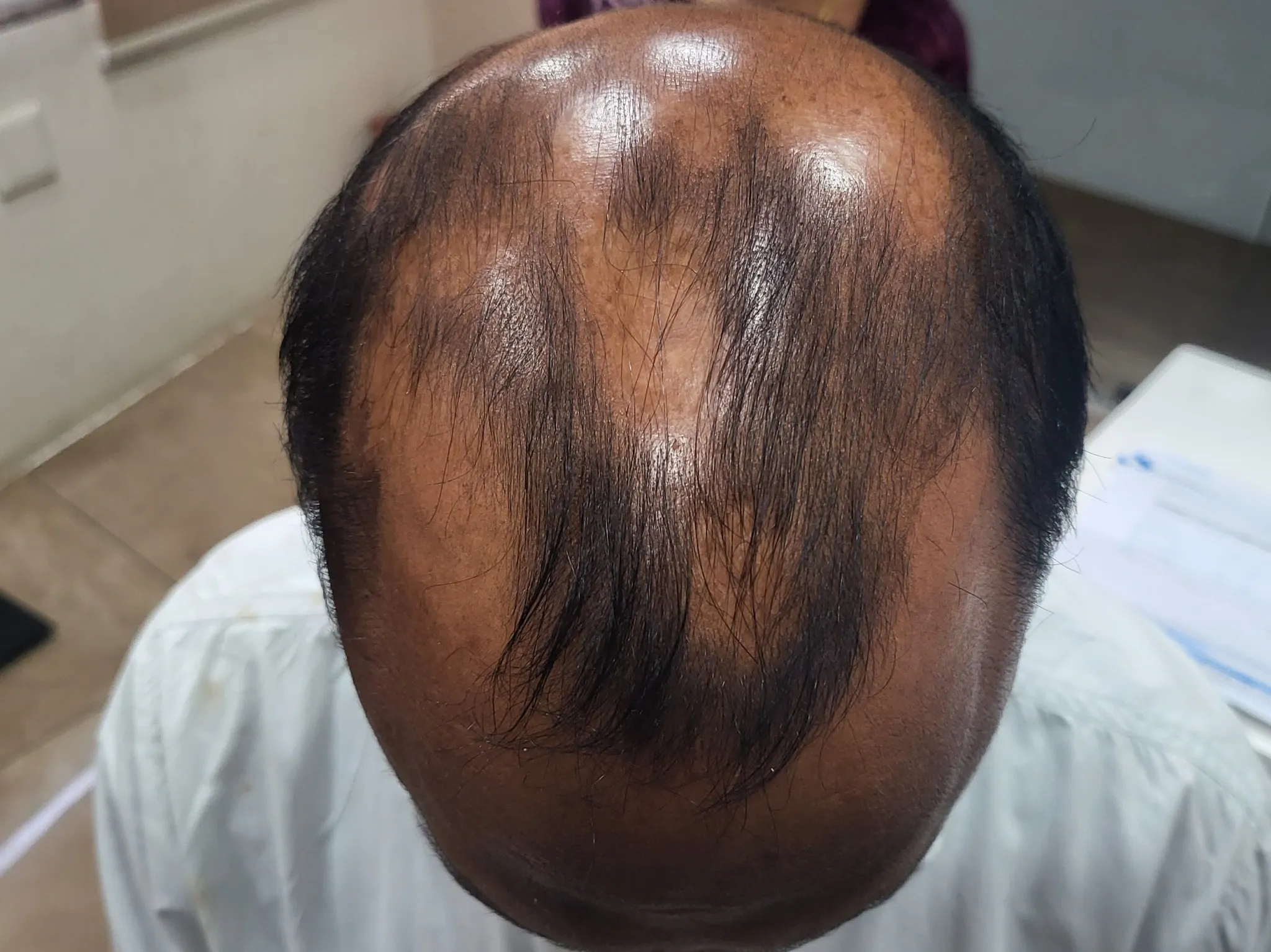 एंड्रोजेनेटिक एलोपेसिया बाल झड़ने के लिए ऑनलाइन उपचार