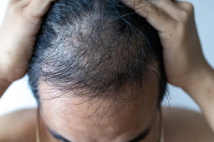 एंड्रोजेनेटिक एलोपेसिया हेयर लॉस: प्रमुख कारक