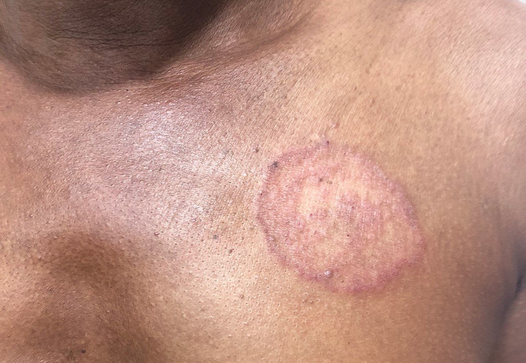 आईये समजते है रिंगवर्म (दाद) क्या है?