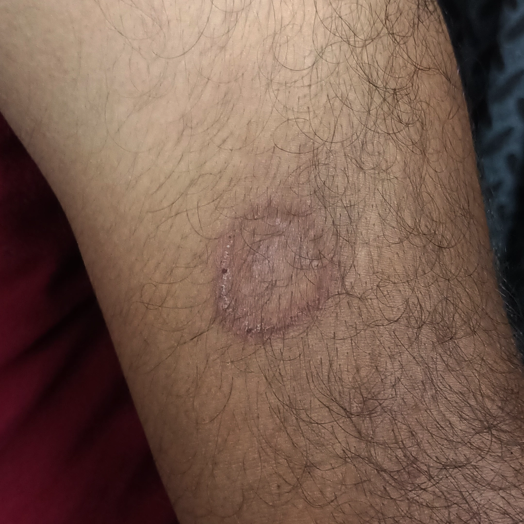 रिंगवर्म ट्रीटमेंट के लिए ऑनलाइन डर्मेटोलॉजिस्ट से कंसल्टेशन क्यों लें?