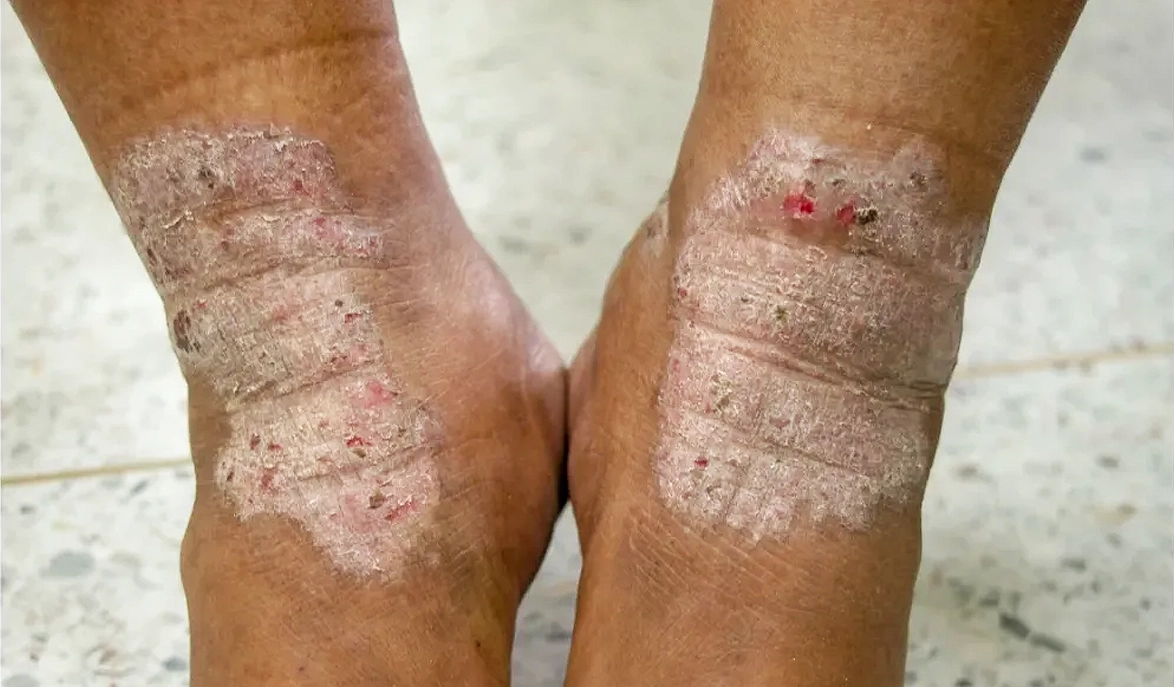 ऑनलाइन एक्जिमा और सेबोरिक डर्मेटाइटिस का इलाज विशेषज्ञों से