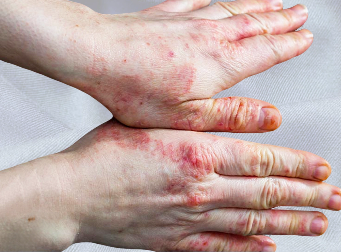 एक्जिमा (खाज)और सेबोरिक डर्मेटाइटिस के लिए अनुशंसित उपचार पद्धतियाँ