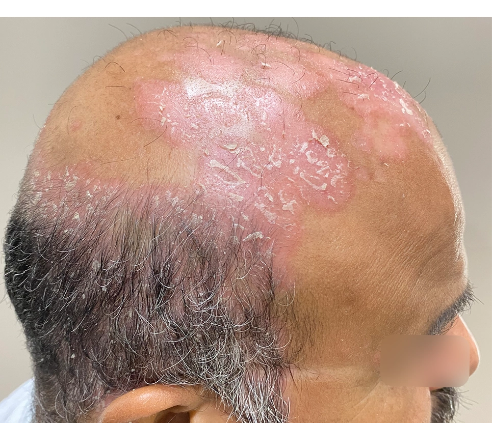 Plaque & Scalp Psoriasis Treatment Online From a Specialist