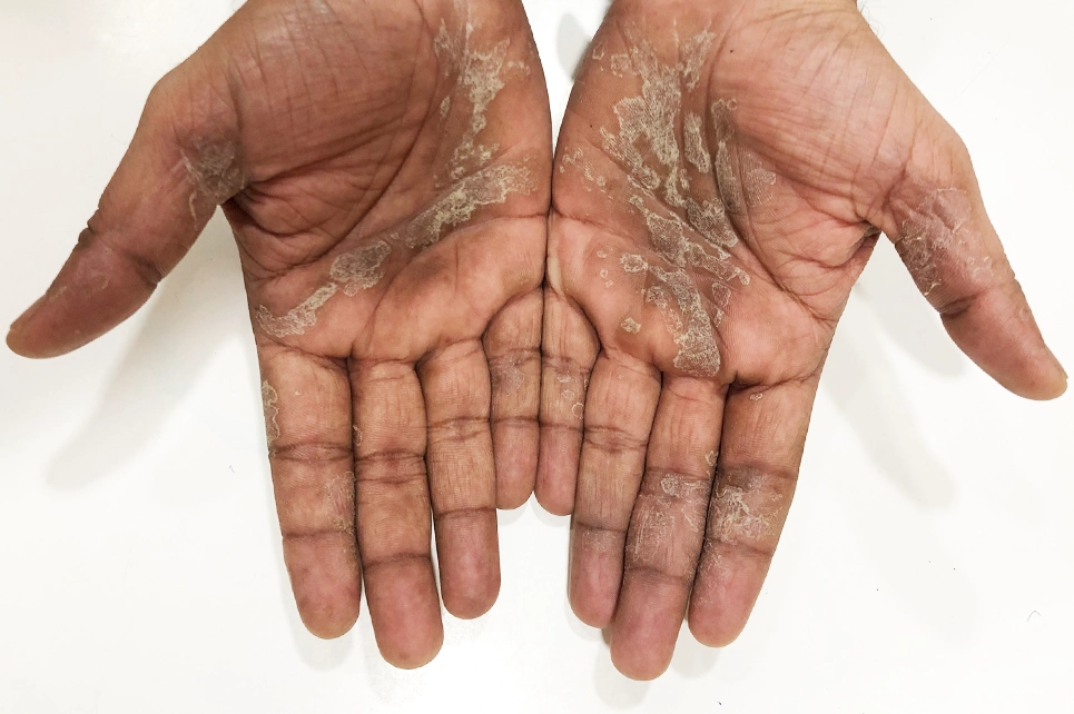 Recognizing Scalp Psoriasis & Plaque Psoriasis Symptoms