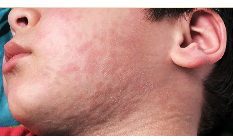 ऑनलाइन पित्ती (अर्टिकेरिया या हाइव्स ) रैश के लिए समग्र उपचार योजना