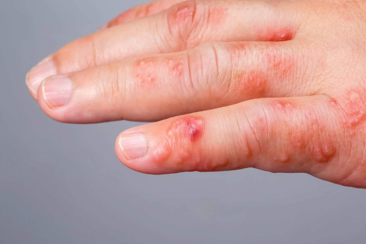 Types of Scabies Infection & How It Affects the Skin