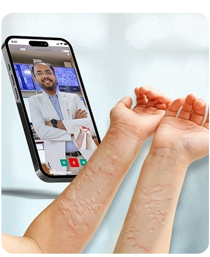 ऑनलाइन अर्टिकेरिया या पित्ती रोग के उपचार के लिए निओडर्मेटोलॉजिस्ट क्यों चुनें