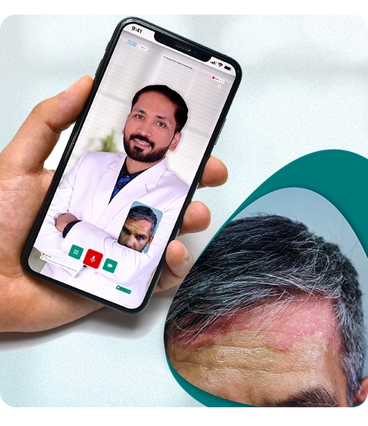 What Our Doctor Says About Scalp & Plaque Psoriasis Treatment