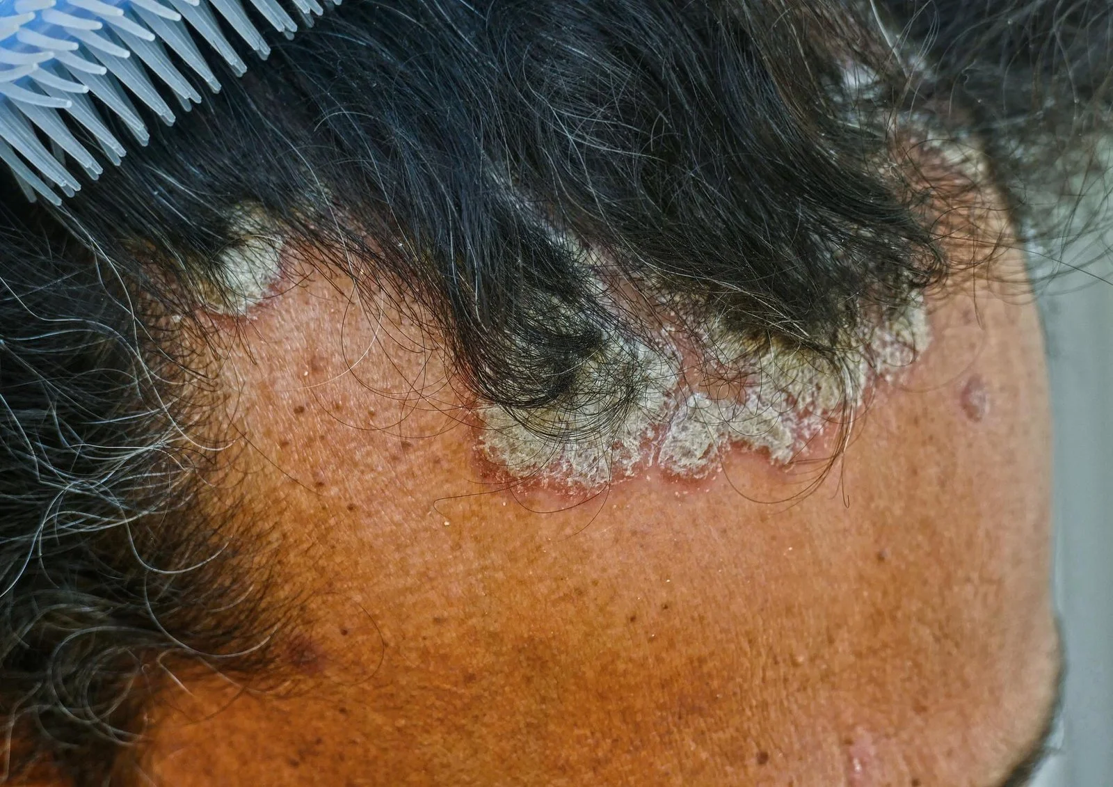 Scalp Plaque Psoriasis Consultant Treatment - Online By Specialist Dermatologists