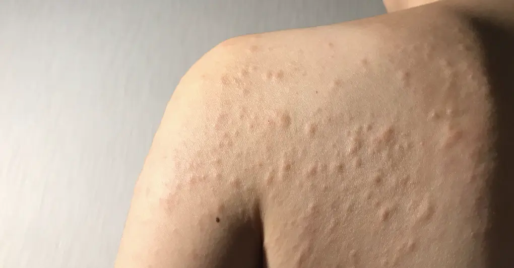Urticaria Hives Online Treatment Consultation - पित्ती , चकत्ते का इलाज