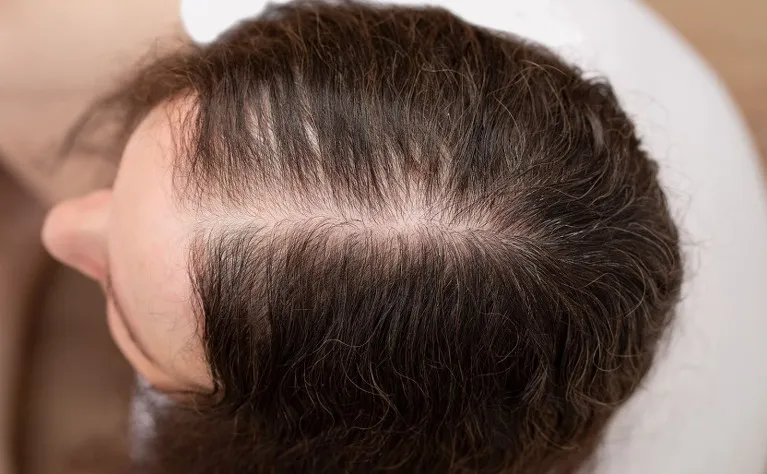 Alopecia Androgenetica Treatment Consultant Online By Neodermatologist
