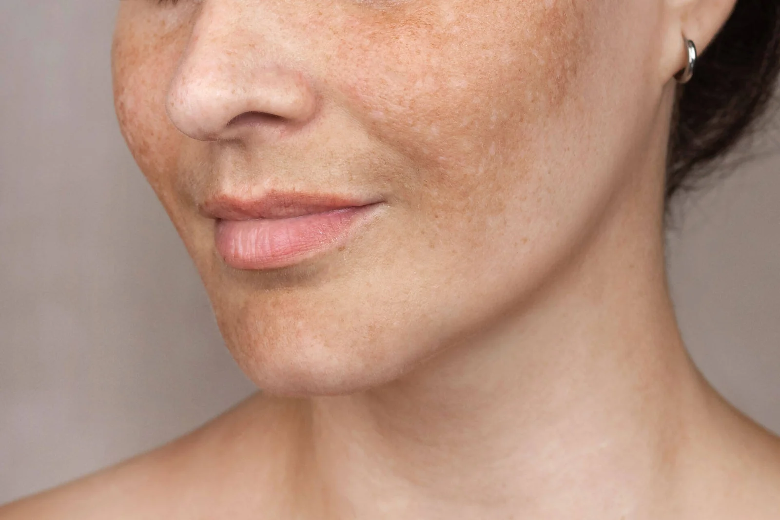 Get Melasma Treatment From Home - Neodermatologist Online Dermatology Consultation