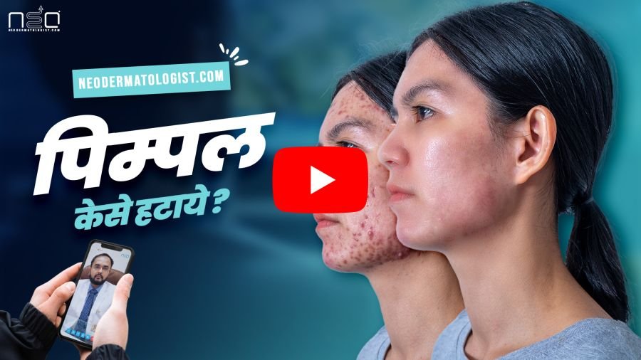 पिंपल्स को कैसे हटाएं - डॉ. रुचिर शाह से विशेषज्ञ सलाह और ऑनलाइन उपाय